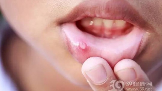 冬季“干燥上火”導致口腔潰瘍？四個細節要注意